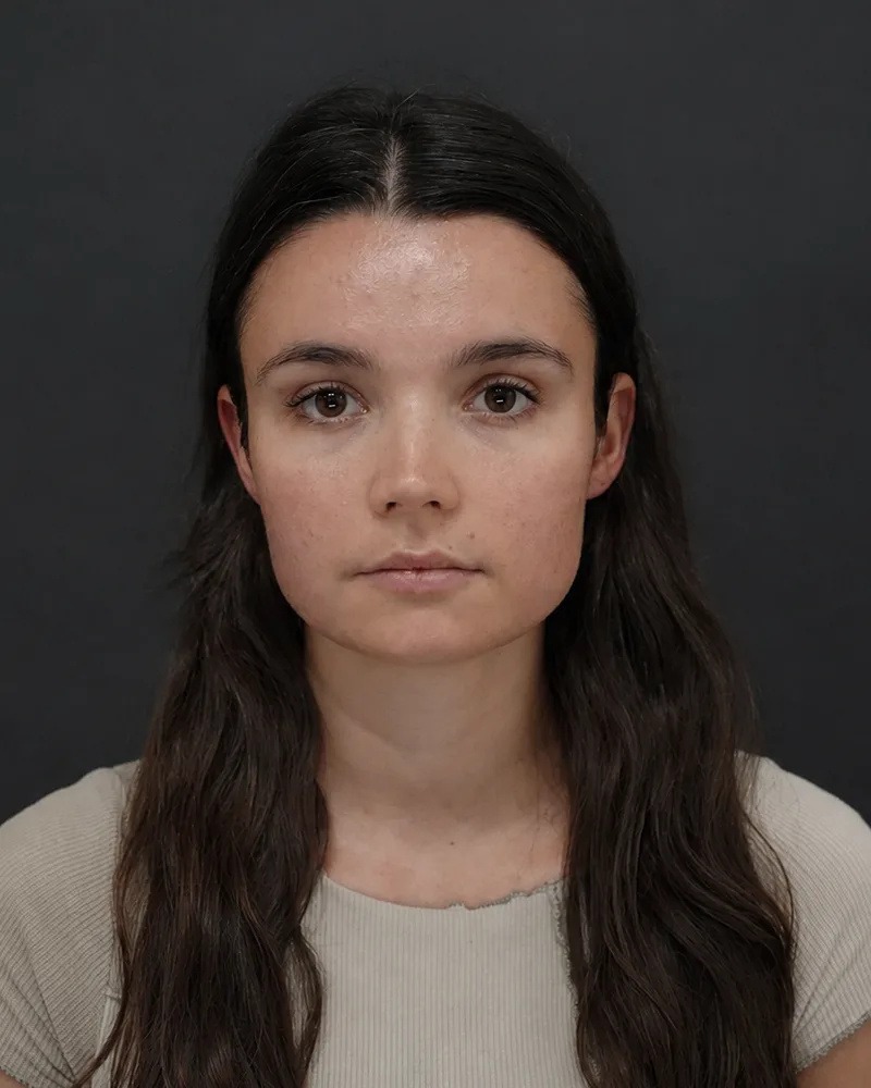 Patient one before treatment, facing the camera